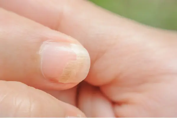 Psoriasi delle unghie – da cosa deriva e come curarla?