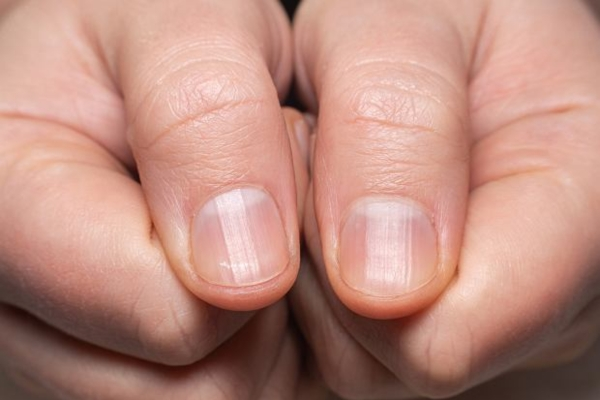 Gewellte Nägel - wie heilt man Nagelrillen?